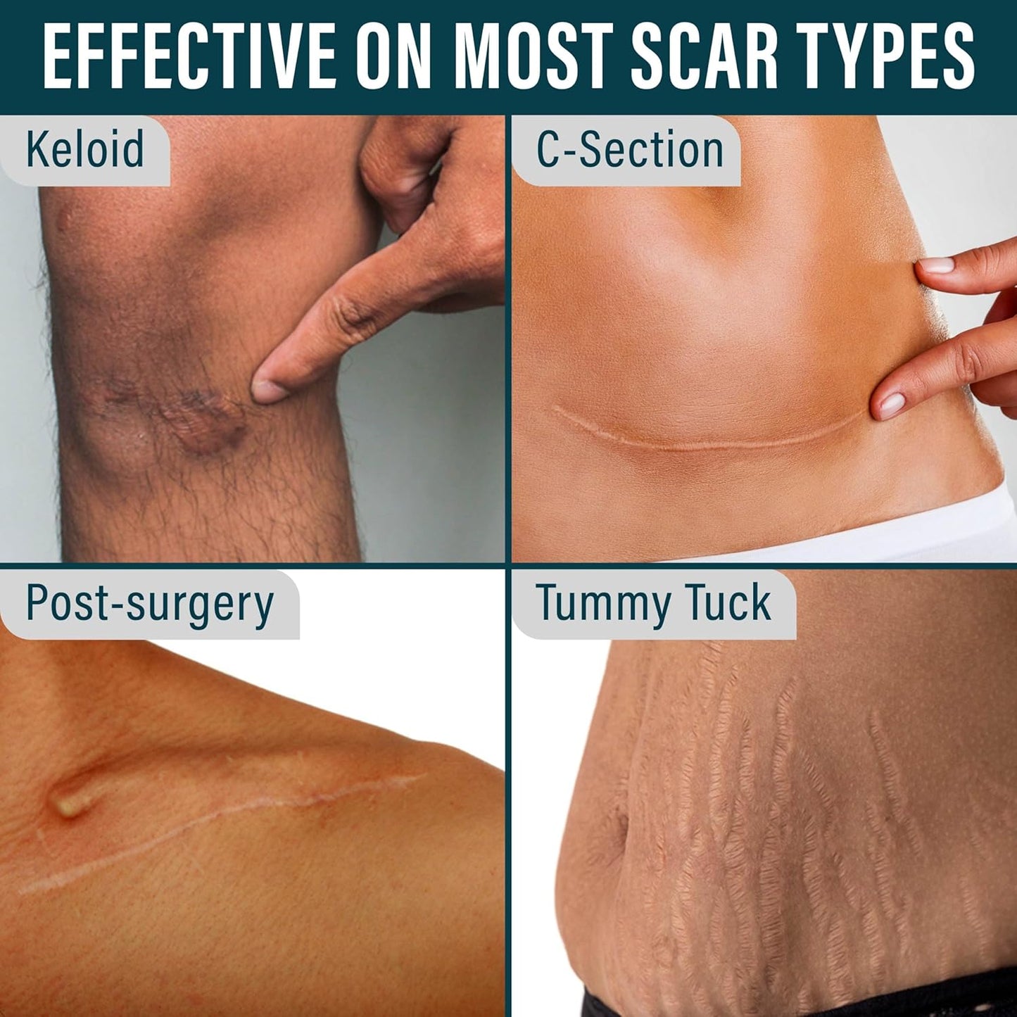Medical-Grade Silicone Scar Tape